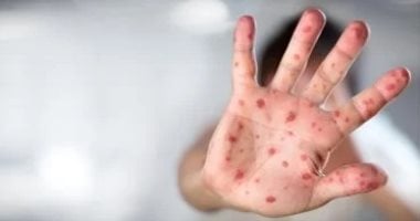 إرشادات جديدة من الصحة العالمية للوقاية من جدرى القرود